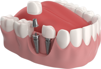 Implantes Dentários